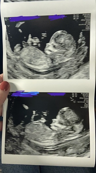 Gender guess ahead of scan tomorrow?