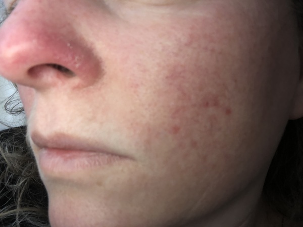 Rosacea. What works and what doesn't.