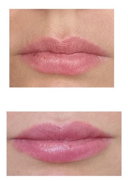Just had my lips done