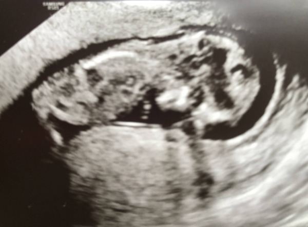 Do you want me to guess the sex? 12 week scans.