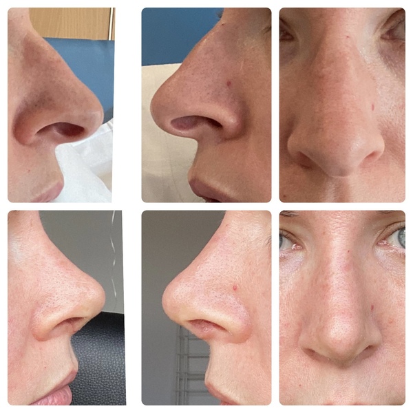 Considering Rhinoplasty