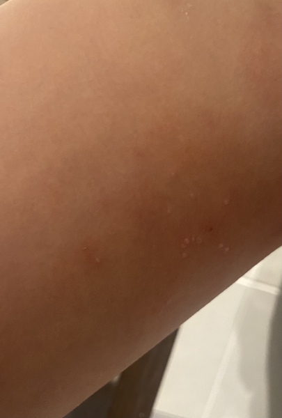 What is this on my child’s leg?