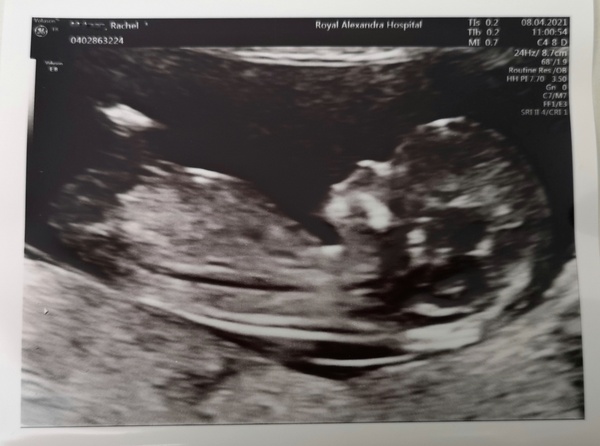 Pregnancy after loss - Autumn Babies 2021 - Thread 3