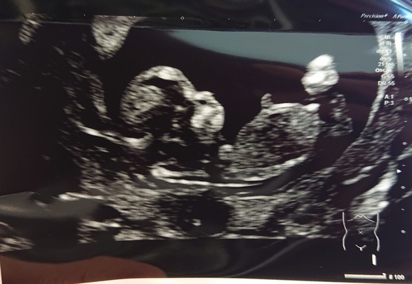 Do you want me to guess the sex? 12 week scans.
