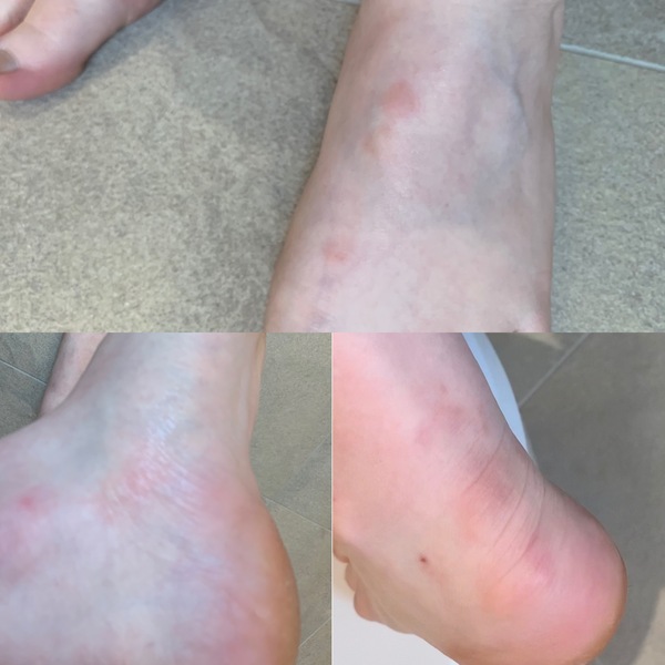 Itchy feet that look like bites but aren’t?