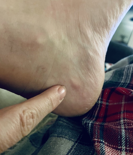 Pic attached- any podiatrists around? What is this?