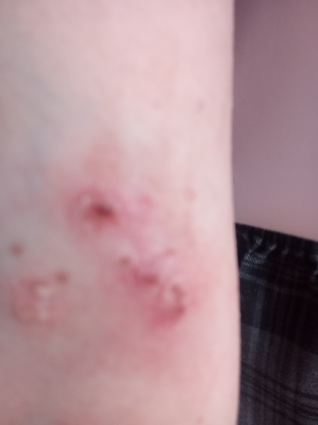 School refusing to give antibiotics