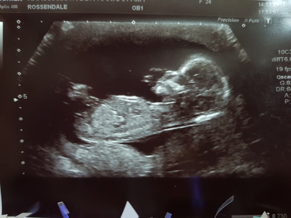 Concerned slightly - 12 week scan pic