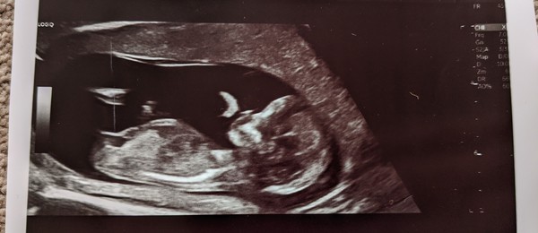 Do you want me to guess the sex? 12 week scans.