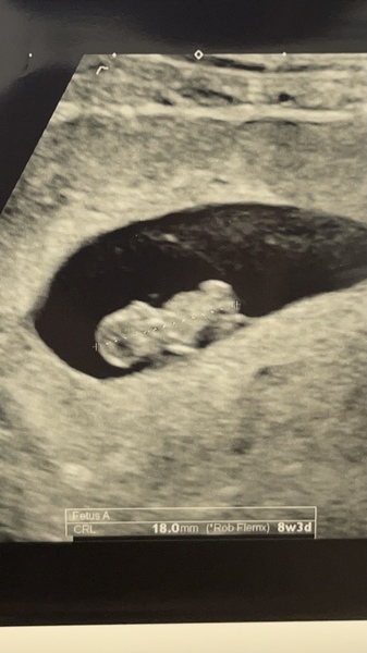Early scan at 9 weeks aniexty, what to expect?