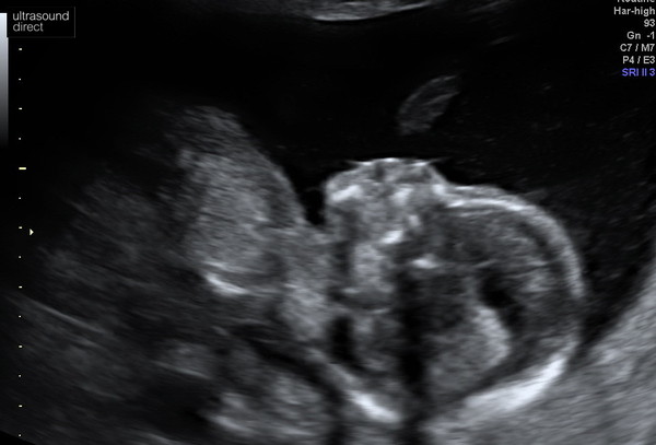 High Risk for Down Syndrome/Edwards-Positive Stories needed please!