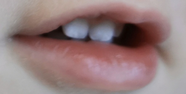 White spots suddenly appeared on toddlers teeth