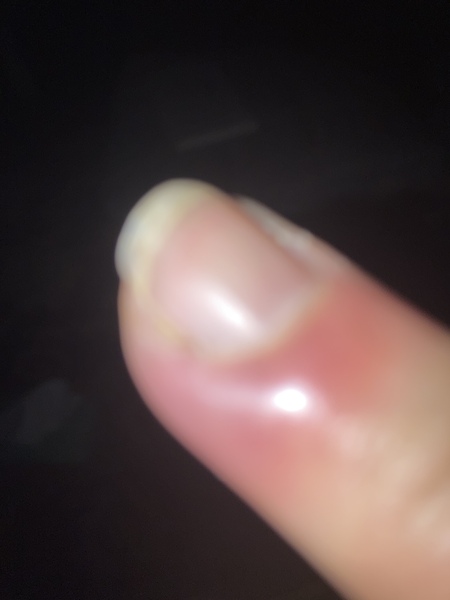 Very red and sore finger