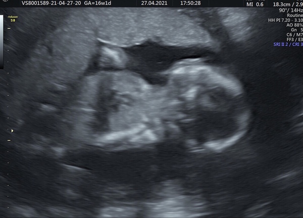 Pregnancy after loss - Autumn Babies 2021 - Thread 3