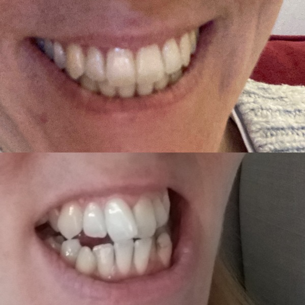 Invisalign when older