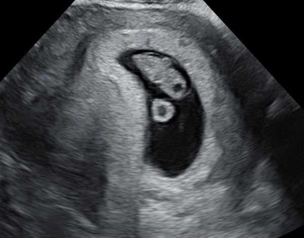 Due November 2021 - thread 2!