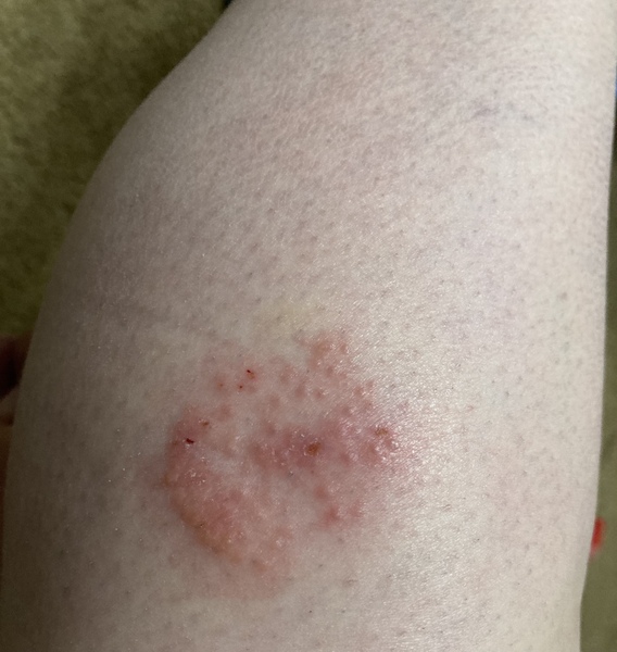 What is this? Odd reaction to a bite?