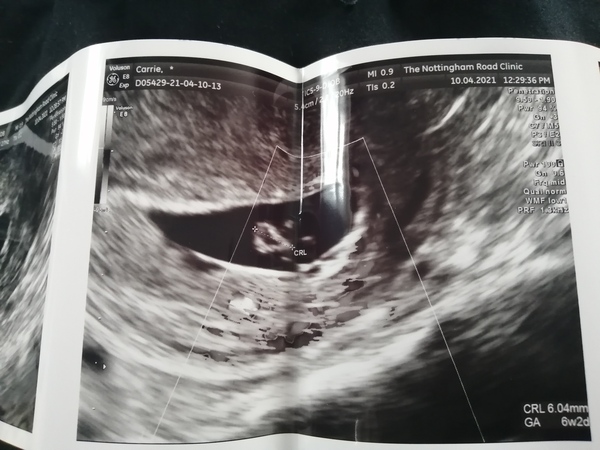 9 weeks since last period measuring 6mm crl no heartbeat
