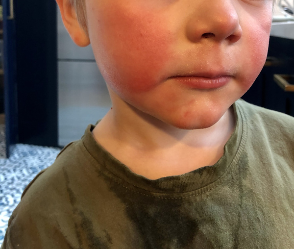 My 4 year olds hayfever is so bad .