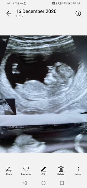Guess gender from Nub pic. BOY or GIRL?