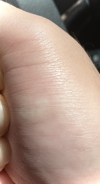 To think I’ve been bitten by a spider?