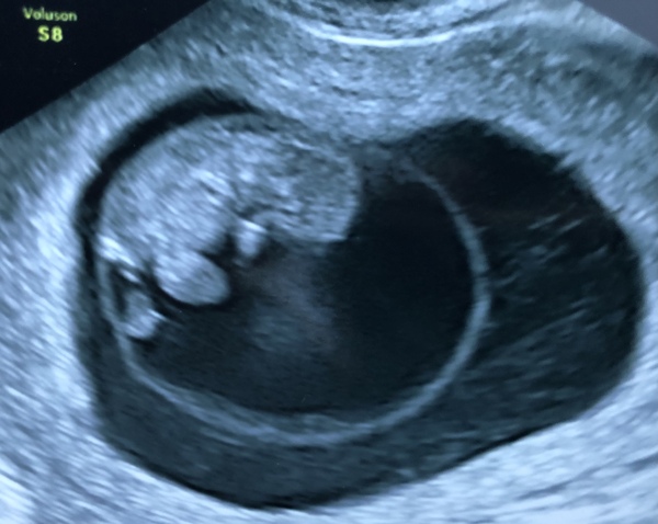 9 week scans