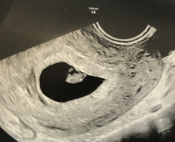 Support for Women who are TTC or Pregnant Following a Termination for Abnormalities- Thread 8