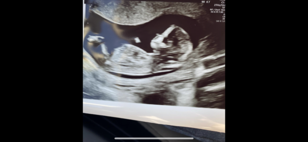 Baby gender