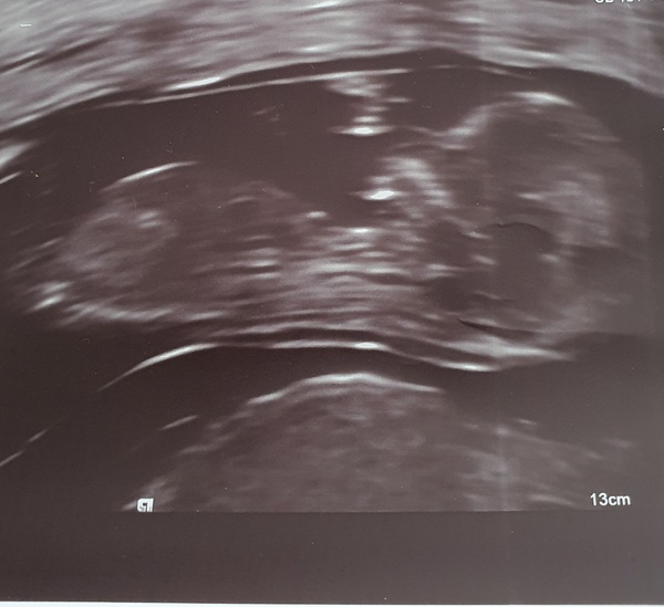 Nub theory 13 week scan