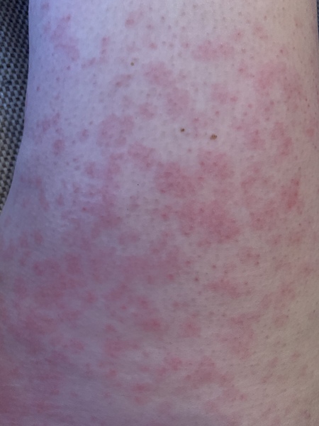 Are these hives?