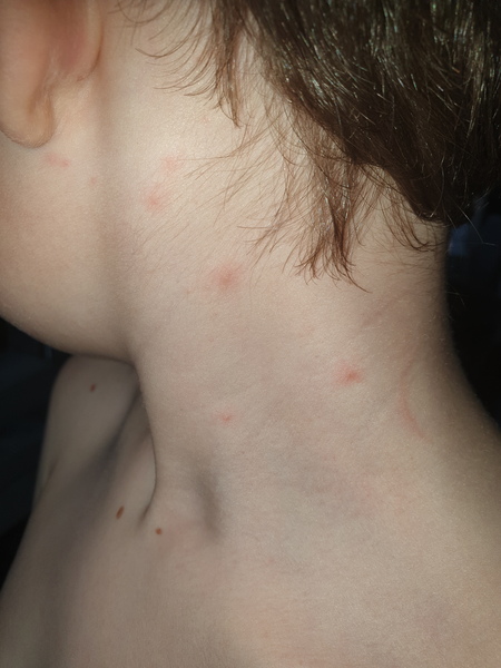Does this look like Chickenpox again?