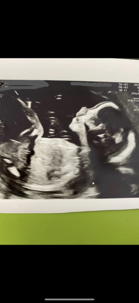 Baby gender