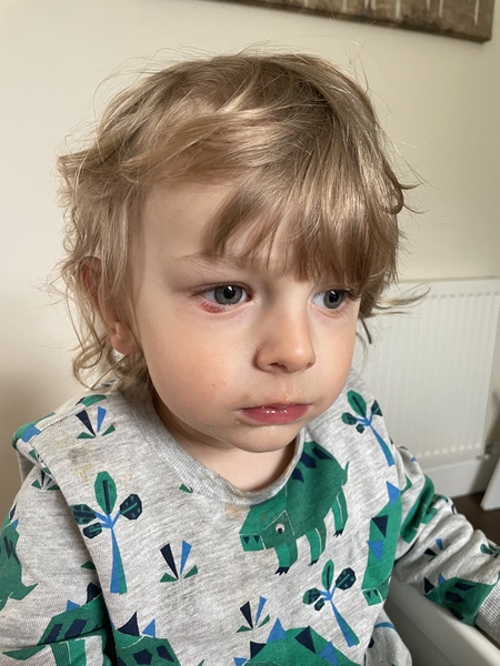 Toddler with chalazion on eye (picture)