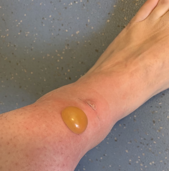 The best thing your body has produced *warning-grim content not suitable for weak-stomached persons*