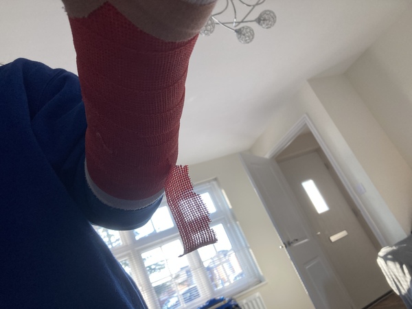 Help! My daughters cast seems to be peeling off 🙄