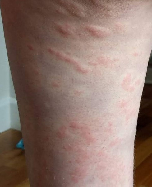 Are these hives?