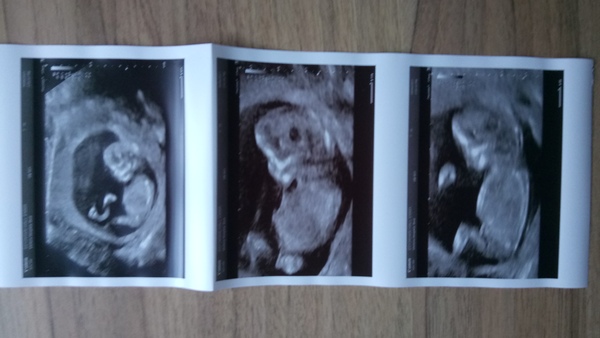 12 week scan girl or boy guesses!