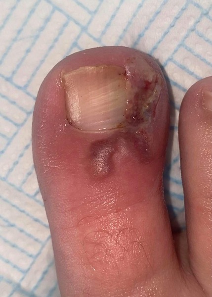 Klaxon - ingrown toe removal picture