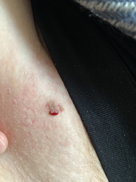 Raised sore mole?