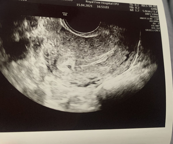 Pregnancy of unknown location