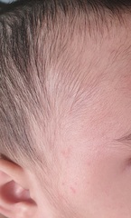 Spots on 6 month olds face