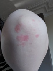 Mystery rash on elbows (pic)