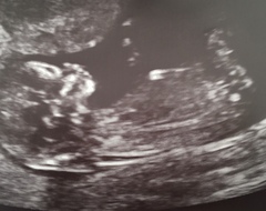 Nub theory guesses? Gender scan in 1 week