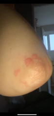 Any one with experience of gluten intolerance/ celiac?? Pics included please help x