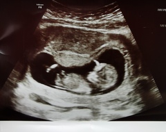 Any gender guessing experts!? 12 weeks 4 days