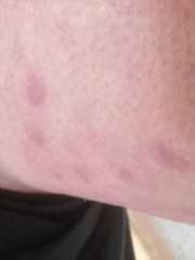 Weird rash / marks on upper thigh