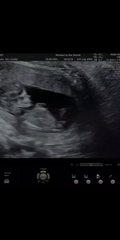 Gender guess 12 week scan