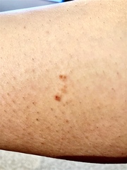 Worrying mole? Pic included