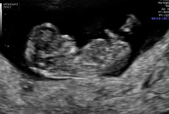 10 week scan - concern