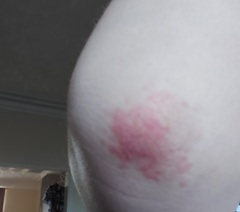 Mystery rash on elbows (pic)